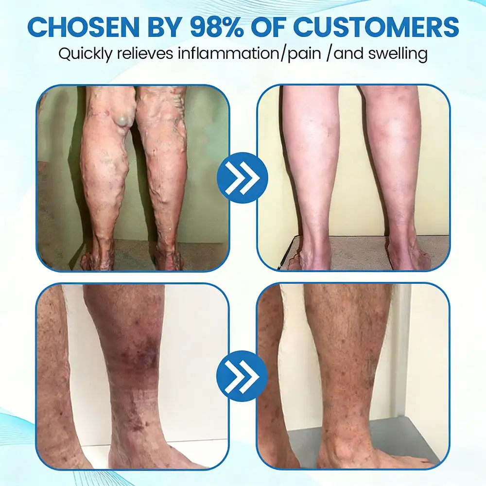 Advanced Vein Healing Spray - Image 5