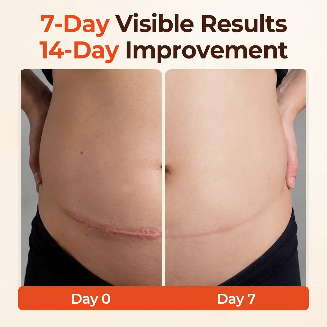 SilkStretch Natural Stretch Mark & Scar Oil - Image 4