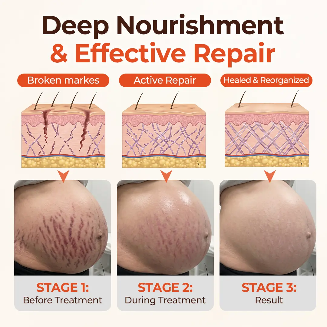 SilkStretch Natural Stretch Mark & Scar Oil - Image 6