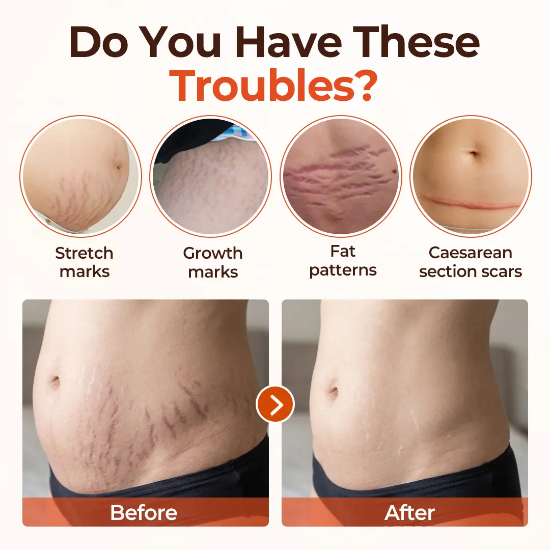 SilkStretch Natural Stretch Mark & Scar Oil - Image 7