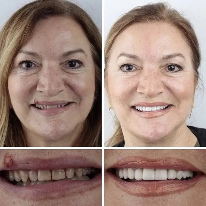 --Advanced Customized Full Denture Set - Image 10