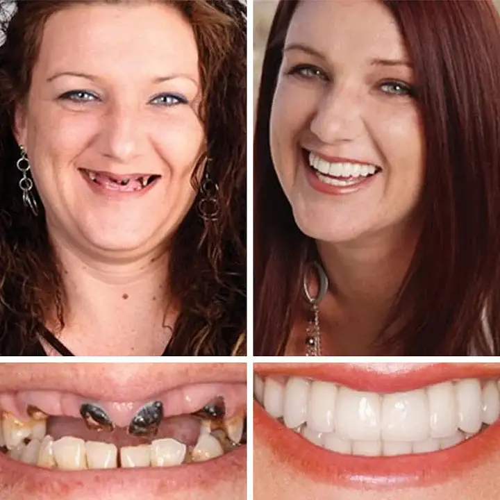 --Advanced Customized Full Denture Set - Image 11