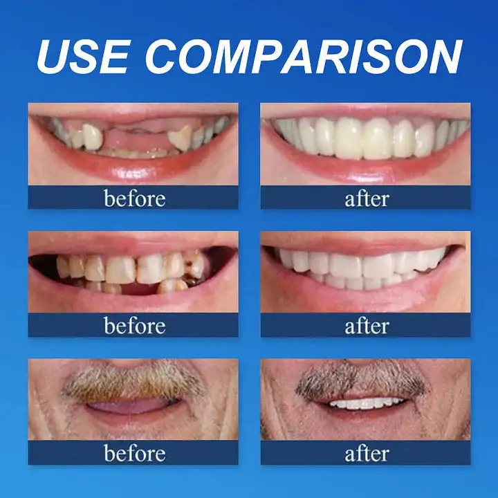 --Advanced Customized Full Denture Set - Image 6