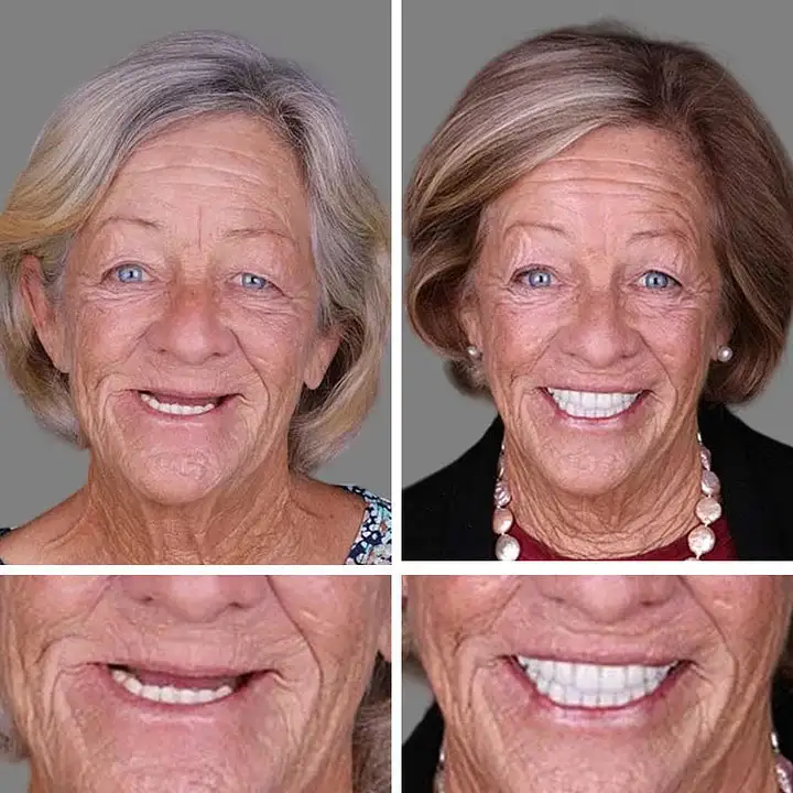 --Advanced Customized Full Denture Set - Image 8