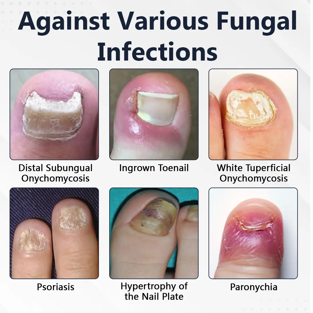 NailFungiClear Pro Antifungal Pen - Image 3