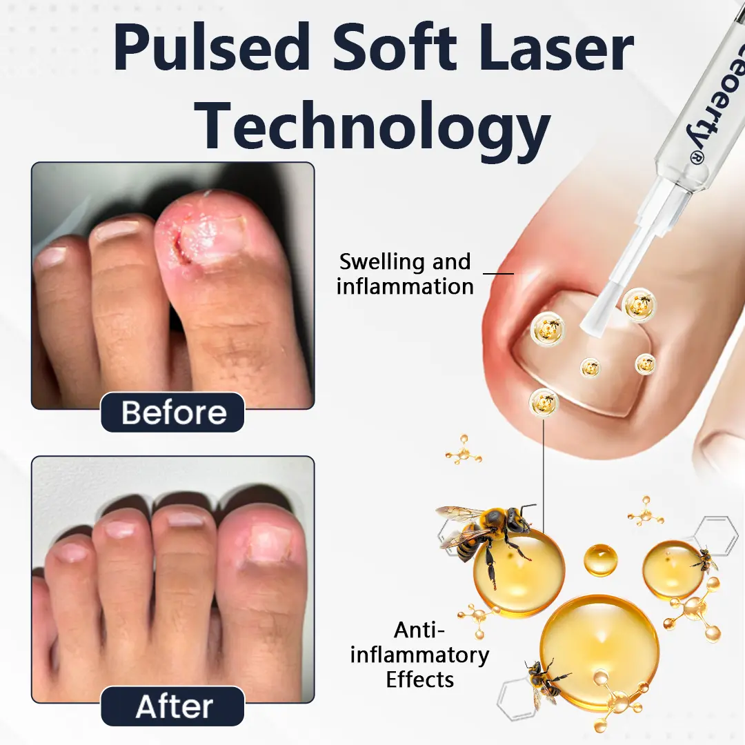 NailFungiClear Pro Antifungal Pen - Image 5