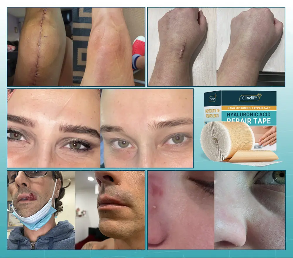 Hyaluronic Acid Nano Repair Tape - Image 14