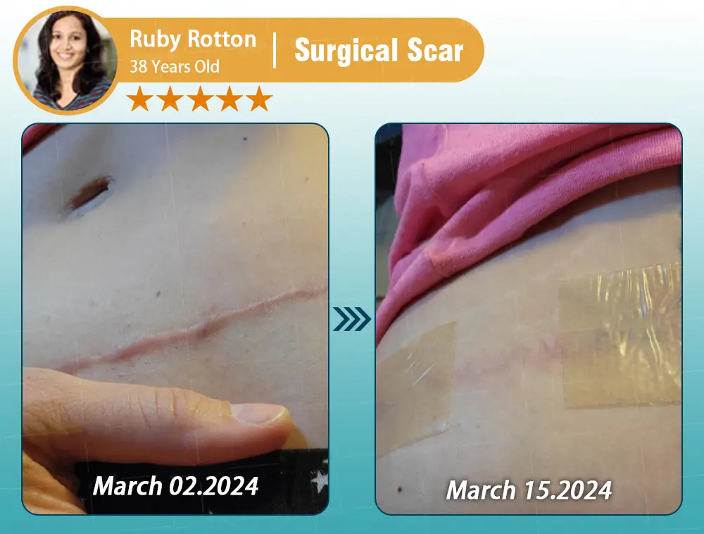 Hyaluronic Acid Nano Repair Tape - Image 30