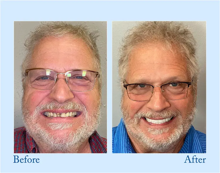 Advanced Customized Full Denture Set - Image 2