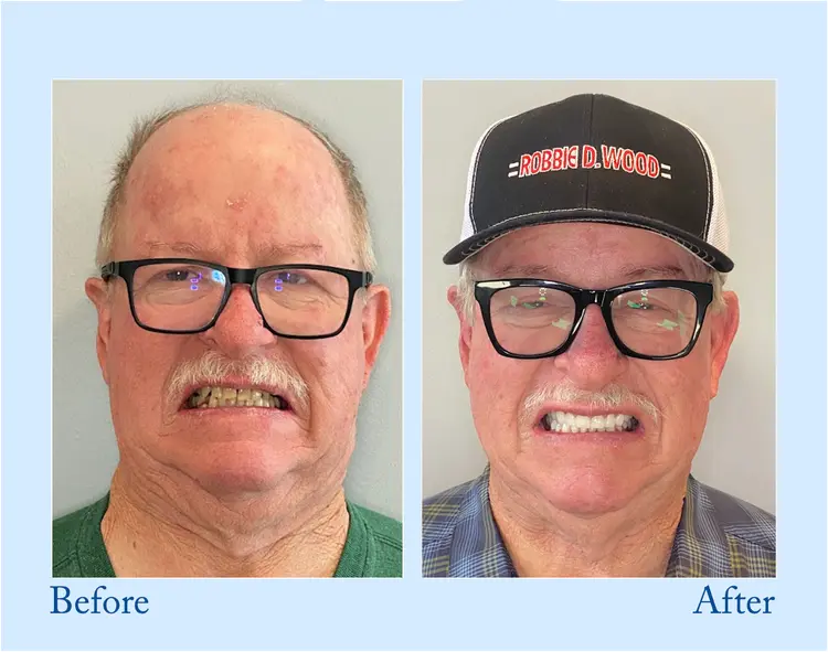 Advanced Customized Full Denture Set - Image 3