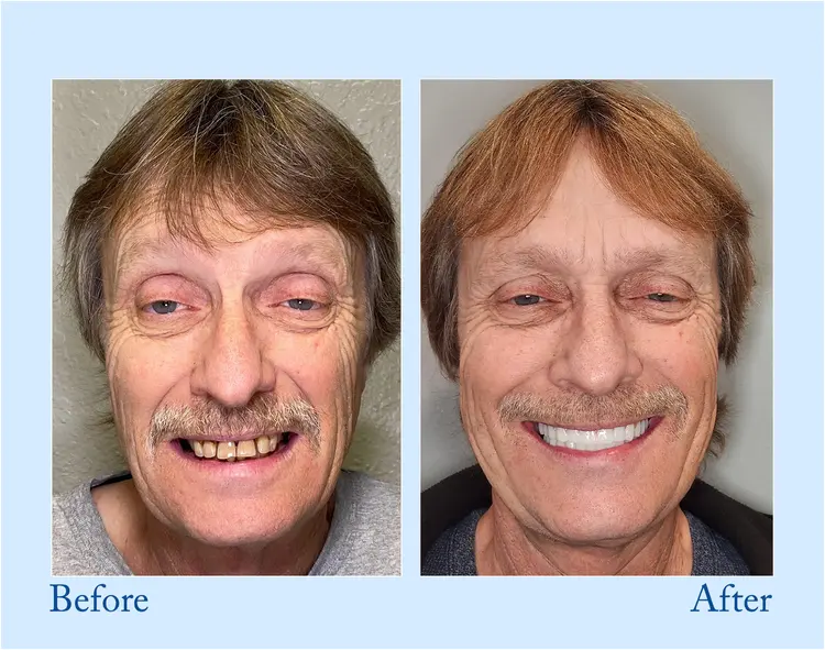 Advanced Customized Full Denture Set - Image 4