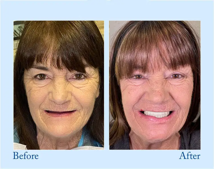 Advanced Customized Full Denture Set - Image 5