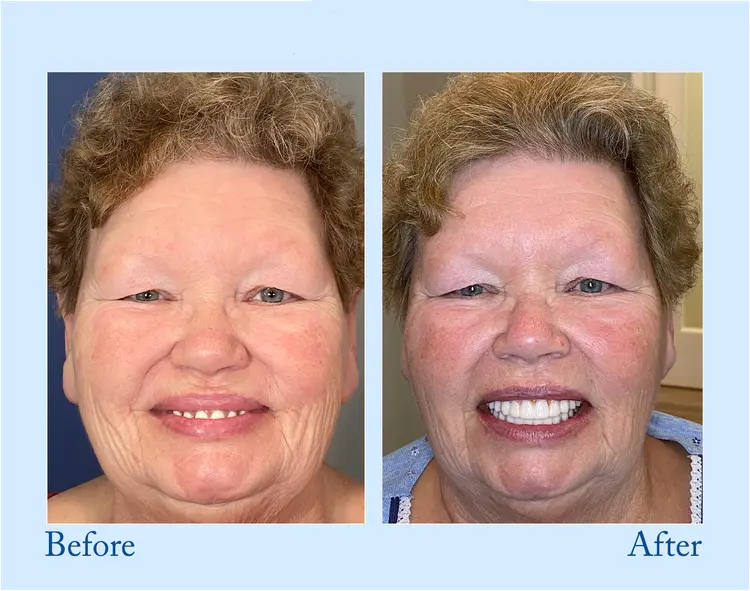 Advanced Customized Full Denture Set - Image 6