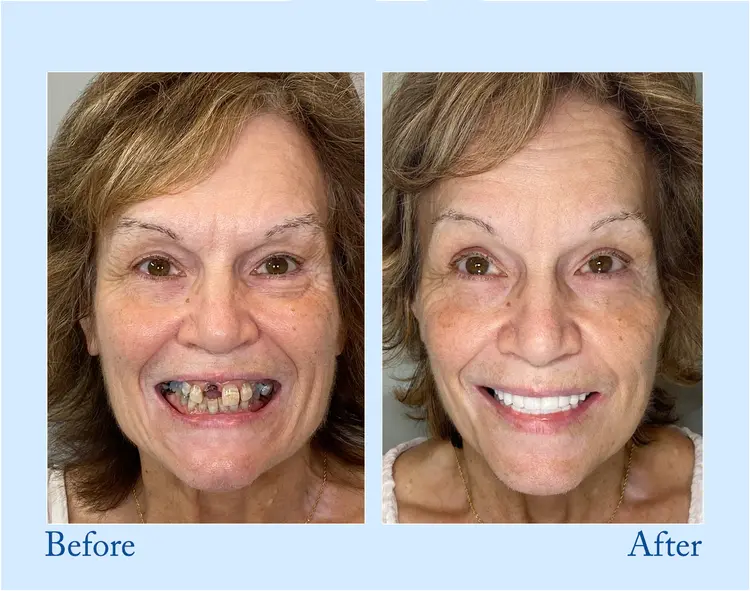 Advanced Customized Full Denture Set - Image 7