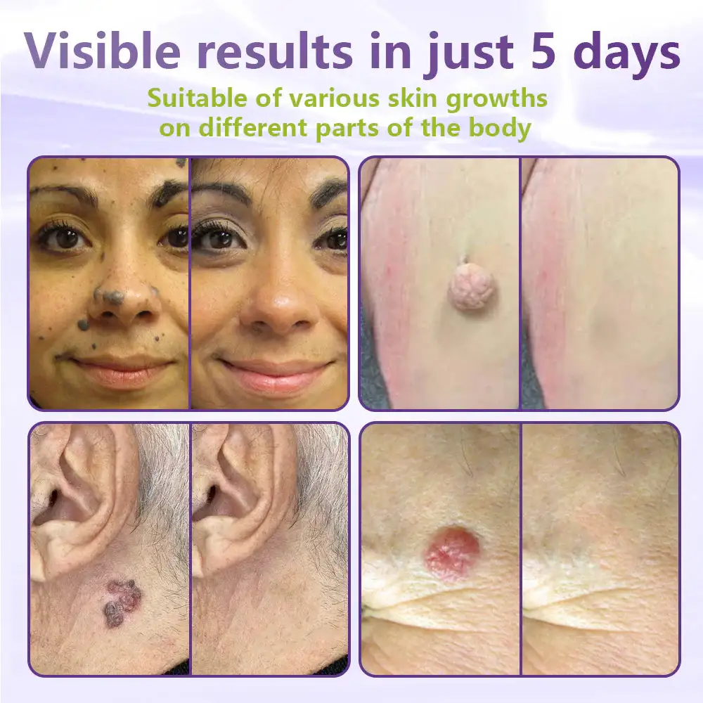 SOLUBLE BOTANICAL SKIN TAG REMOVAL PATCH - Image 5