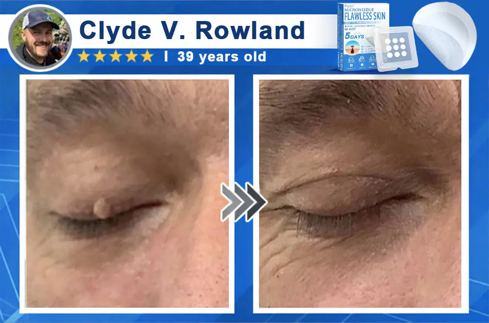 2-in-1 & Hydrocolloid Patch - Image 4