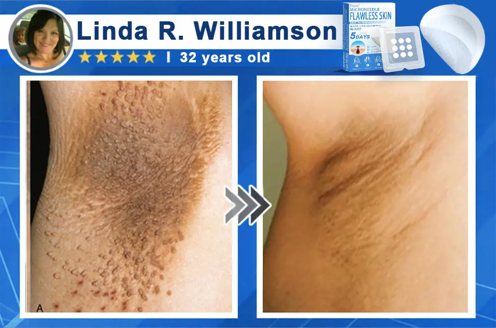 2-in-1 & Hydrocolloid Patch - Image 9