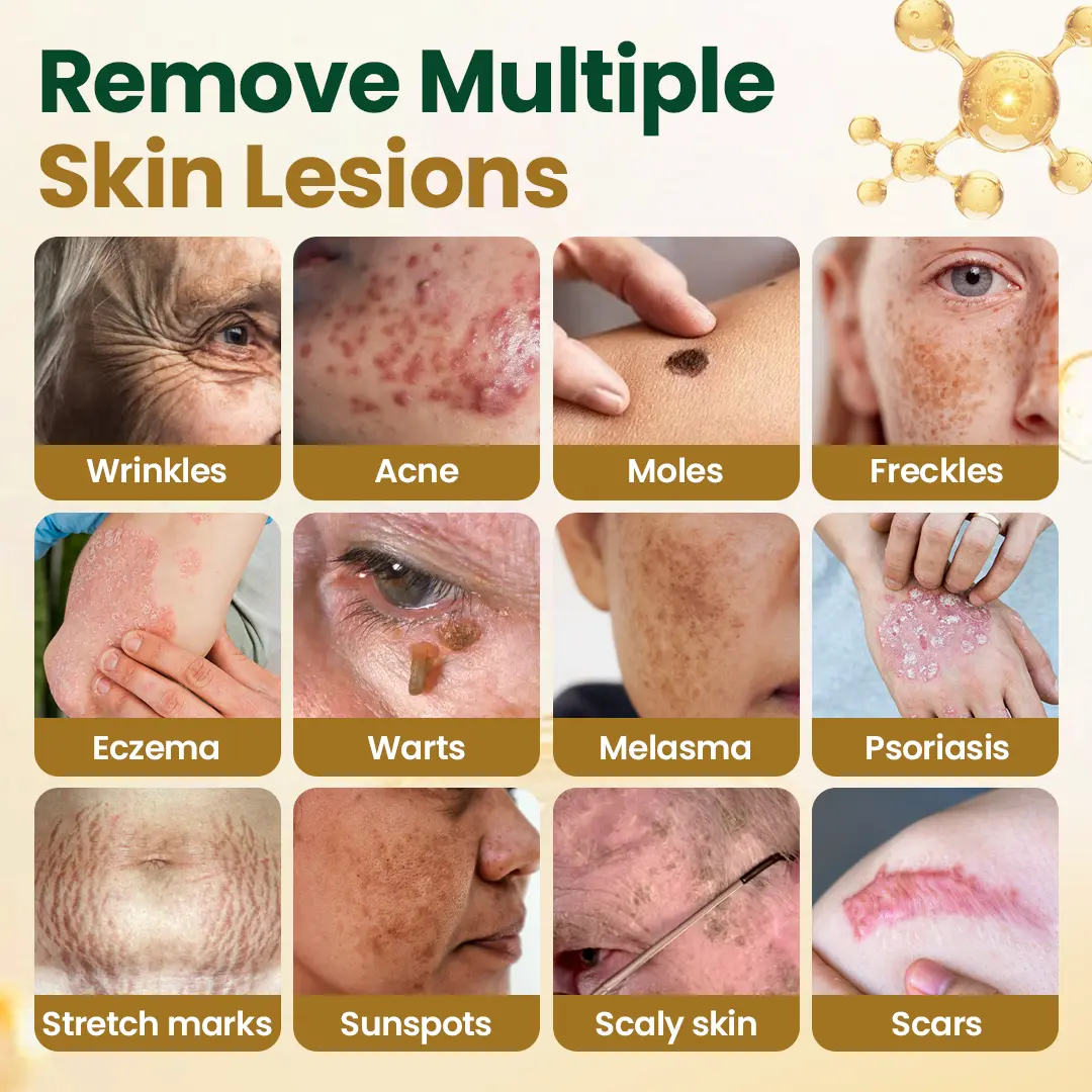 Wart Remover Cream - Image 2