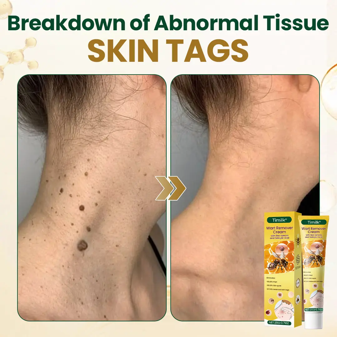 Wart Remover Cream - Image 3