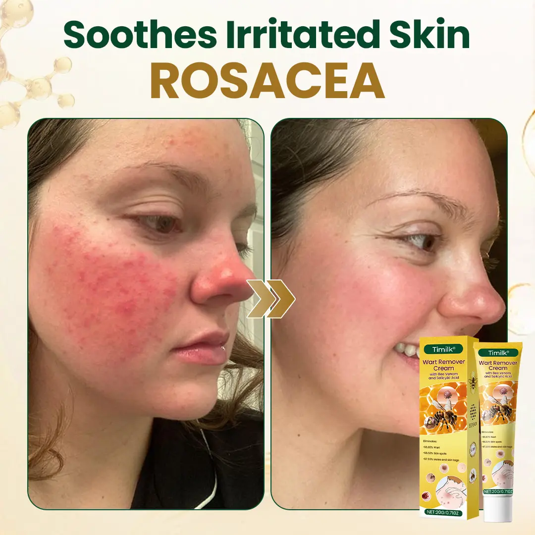 Wart Remover Cream - Image 4