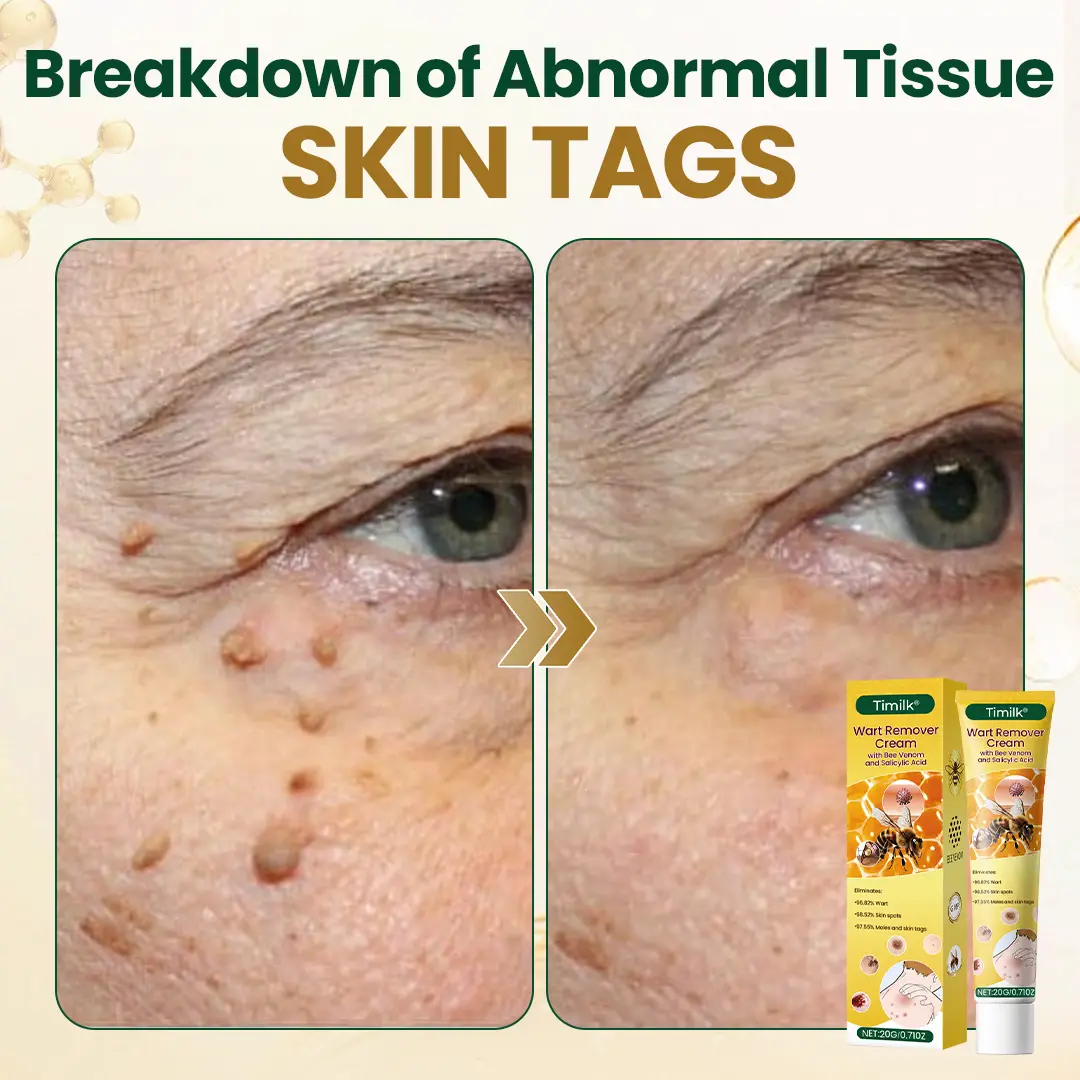 Wart Remover Cream - Image 5