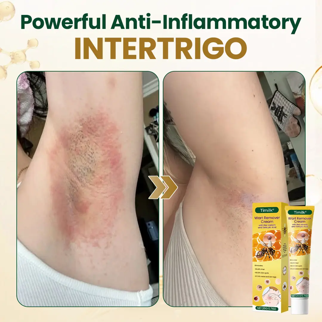 Wart Remover Cream - Image 7
