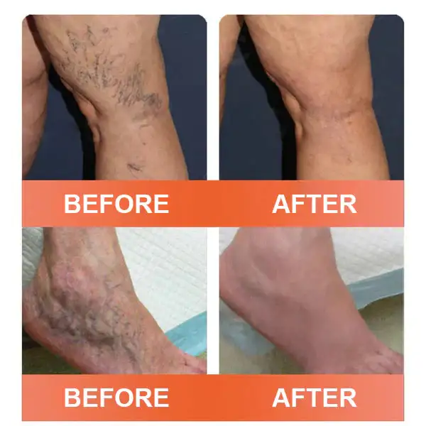 Vein Ease Microneedle Care Patch - Image 6