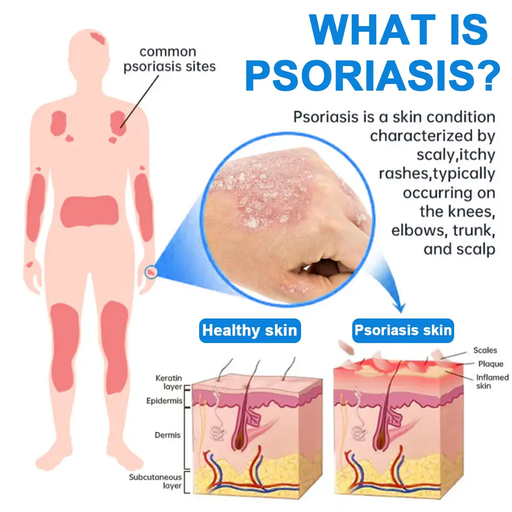 Magnesium Herbal Psoriasis Spray - Image 2