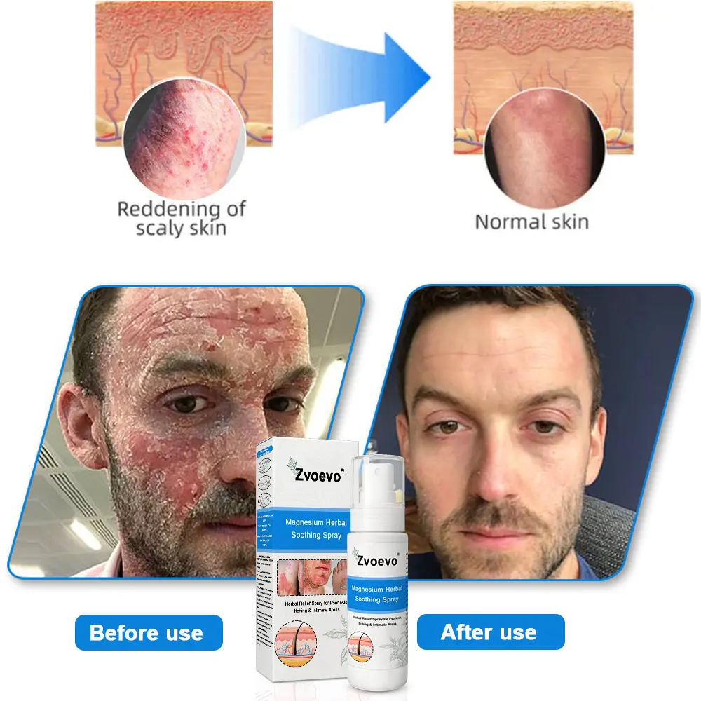 Magnesium Herbal Psoriasis Spray - Image 3