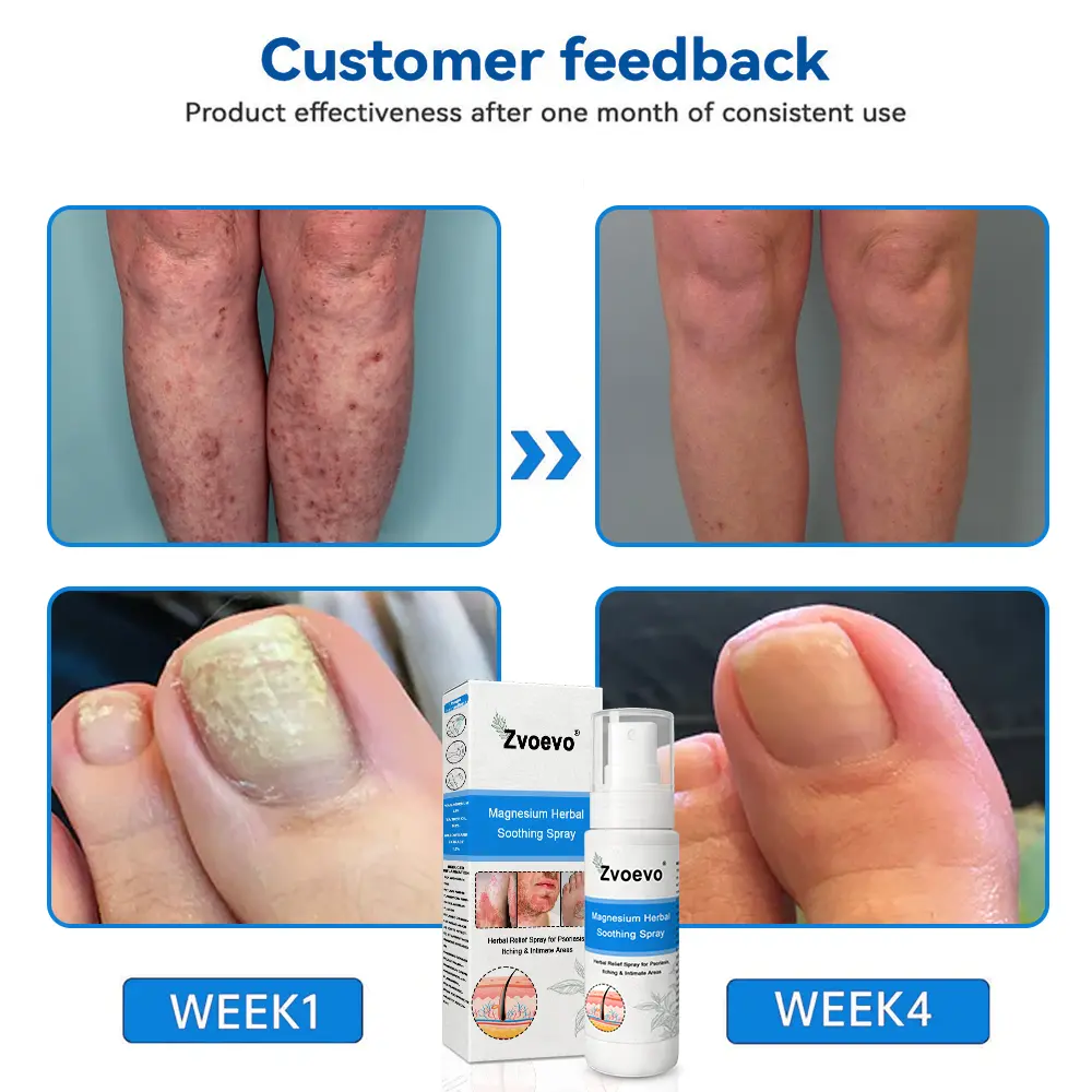 Magnesium Herbal Psoriasis Spray - Image 6