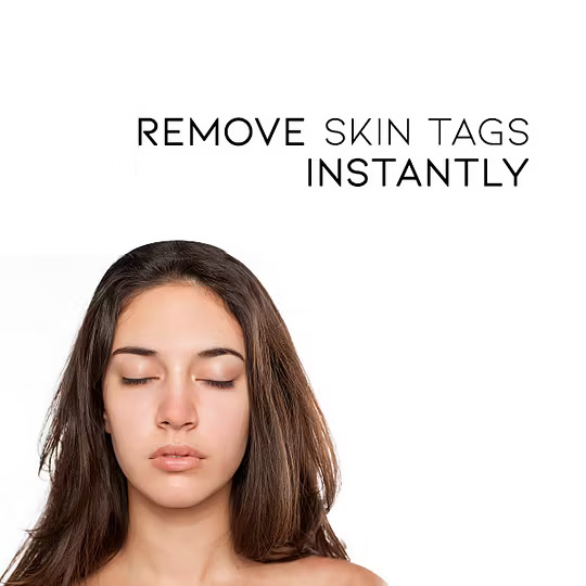 WipeOff Tags & Mole Remover - Image 3
