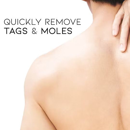 WipeOff Tags & Mole Remover - Image 4