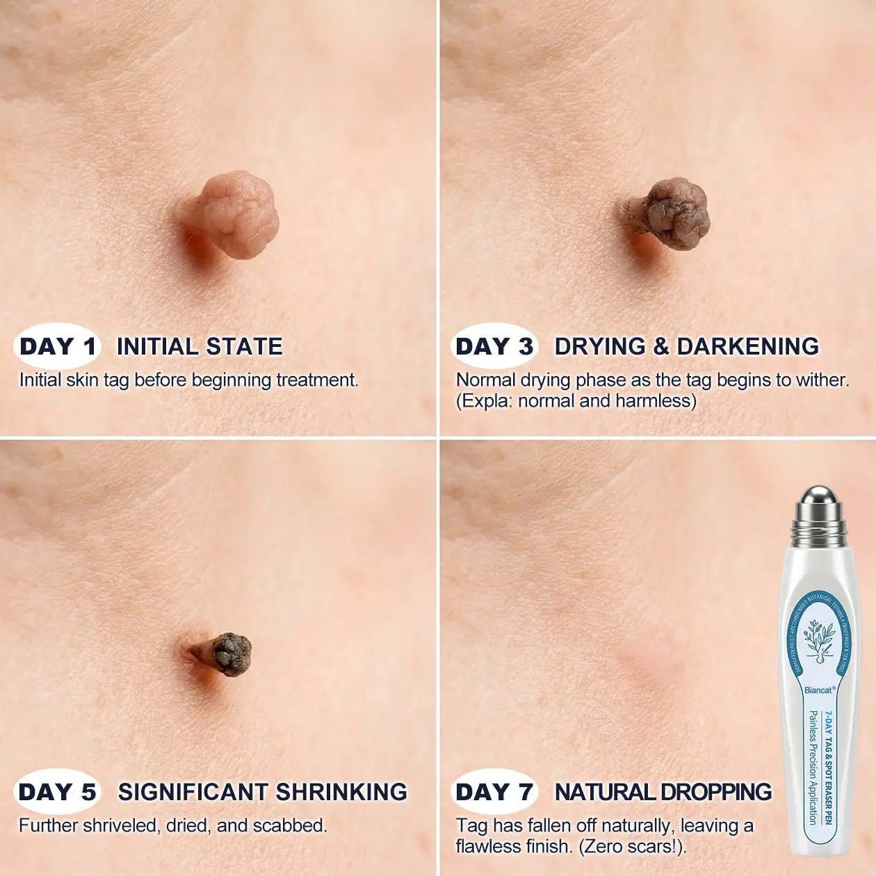 7-Day Skin Tag & Spot Eraser Painless & Scar-Free Advanced Imperfection Removal Rollerball Pen - Image 15