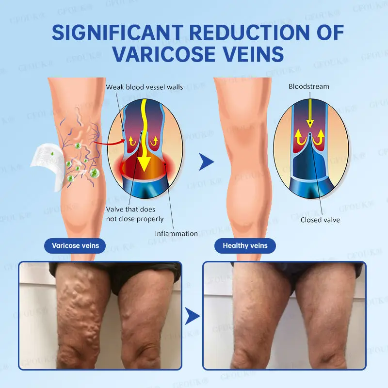 VeinRelief Microneedle Patch - Image 8