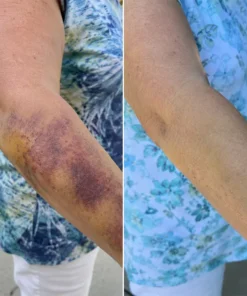 LIMETOW® Arnica Bruise Cream