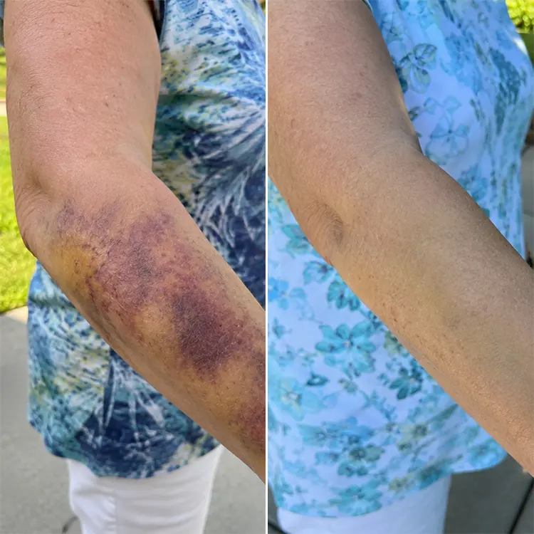 LIMETOW® Arnica Bruise Cream