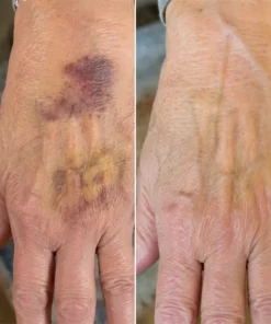 LIMETOW® Arnica Bruise Cream