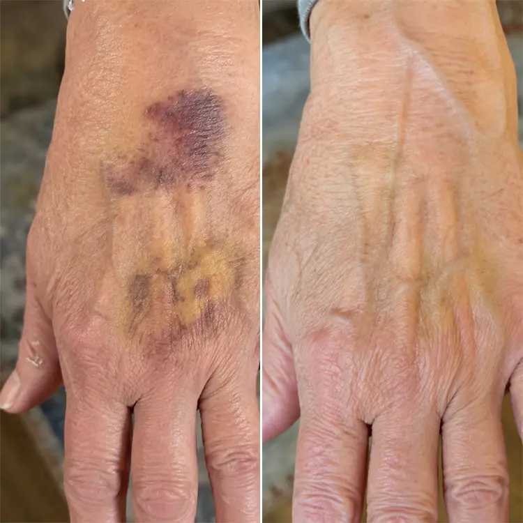 LIMETOW® Arnica Bruise Cream