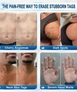 LIMETOW® Skin Tag & Spot Eraser