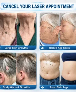 LIMETOW® Skin Tag & Spot Eraser