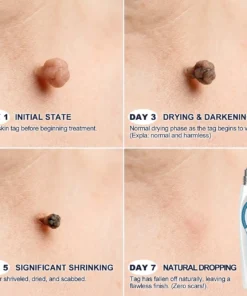 LIMETOW® Skin Tag & Spot Eraser