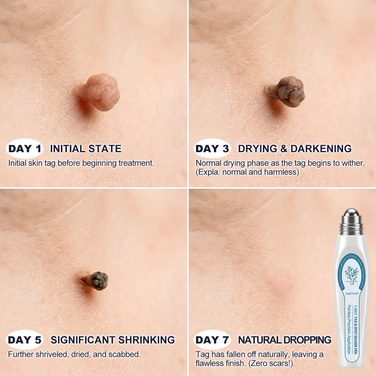 LIMETOW® Skin Tag & Spot Eraser