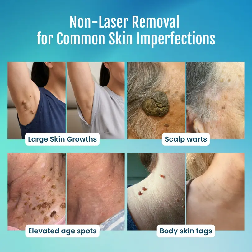 SpotlessPro Advanced Skin Care Pen - Image 2