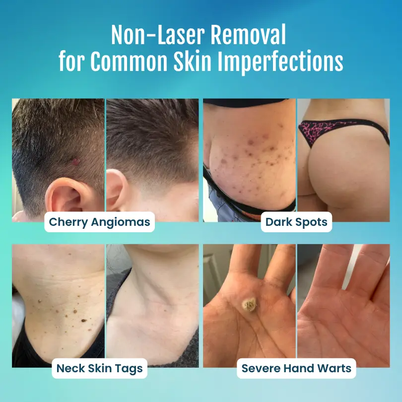 SpotlessPro Advanced Skin Care Pen - Image 3