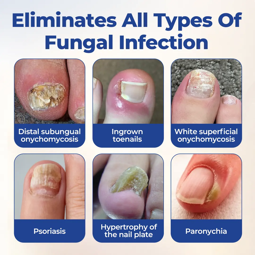 FungiBee Advanced Nail Repair Solution - Image 5