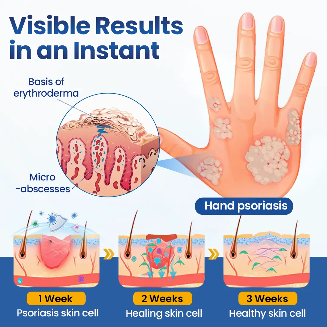 PsoriaMucin No-Rub Itch & Flake Relief Mist - Image 5