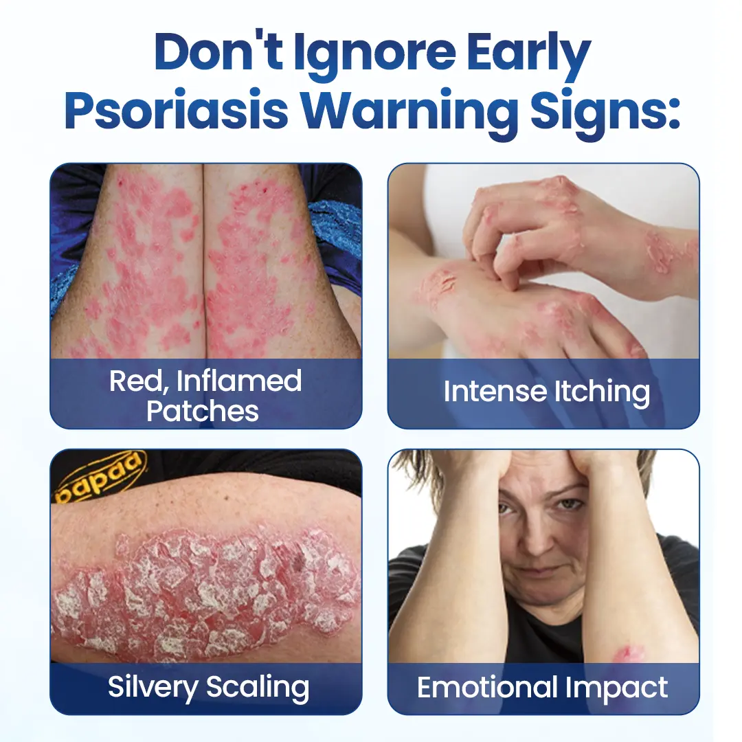 PsoriaMucin No-Rub Itch & Flake Relief Mist - Image 8