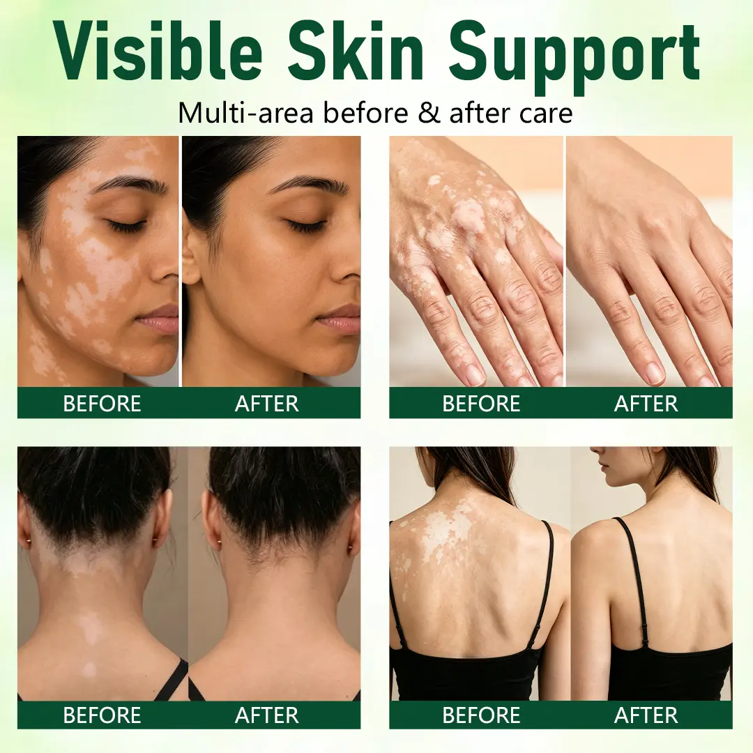 Herbal Vitiligo Cream - Image 2