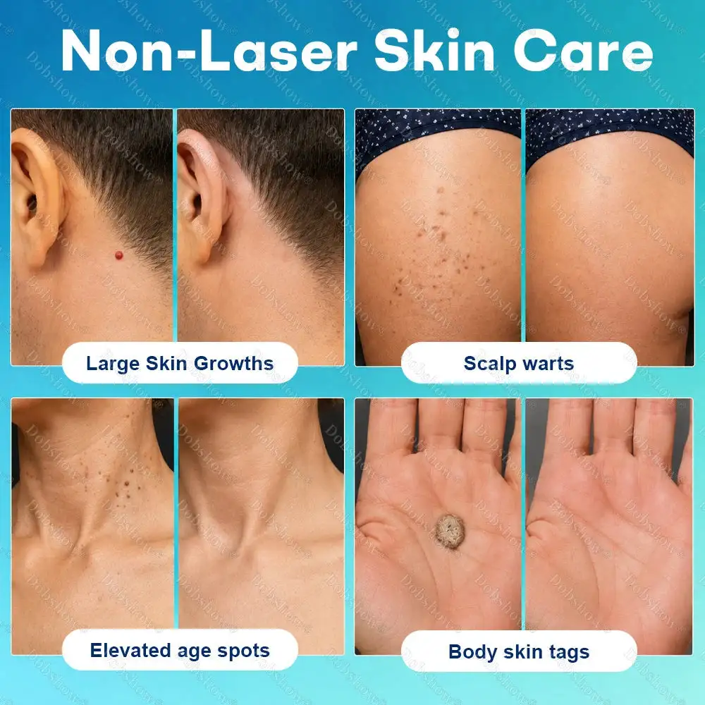 7-Day Blemish Remover Pain-Free & Scar-Free Advanced Roller Pen for Skin Tags and Spots - Image 3