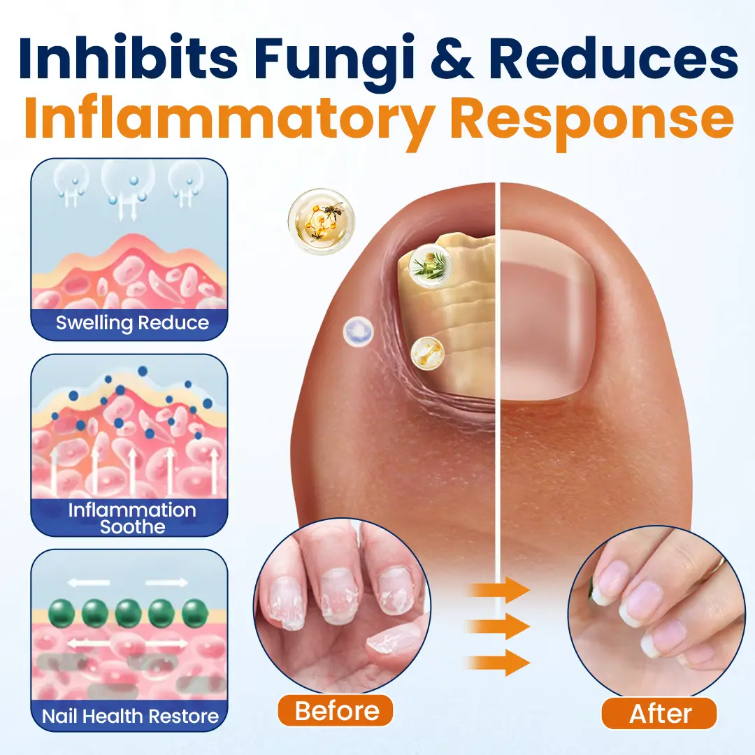 Nail Fungus Relief Spray - Image 4